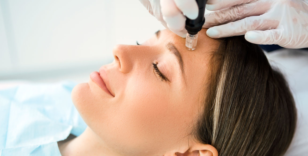 Microneedling